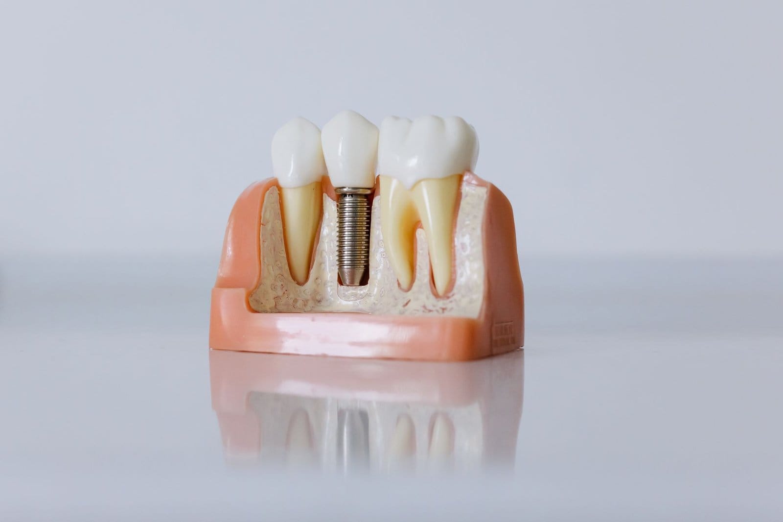 Dental Implants A Permanent Solution for Missing Teeth in Plaistow
